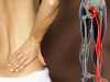 Tổng quan bệnh Đau thần kinh tọa