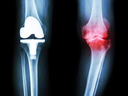 Kết quả Chụp X – quang cho hình ảnh thoái hóa xương khớp