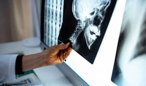 Chụp X quang khớp thái dương hàm giúp bác sĩ dễ dàng quan sát tổn thương và chẩn đoán mức độ thoái hóa